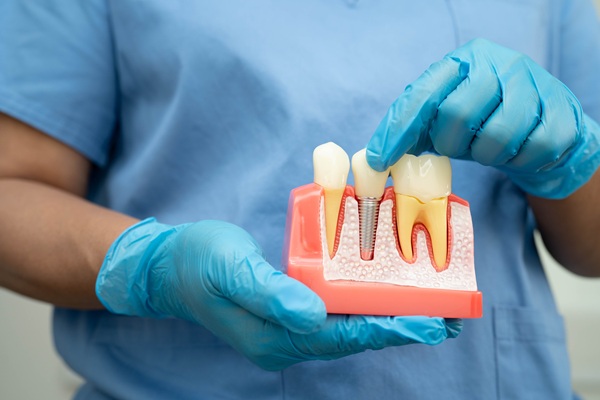 Is Tooth Extraction Necessary Before Receiving Dental Implants?