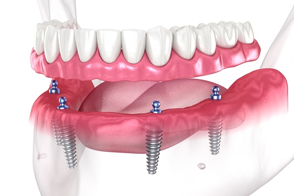 Advantages And Drawbacks Of Implant Supported Dentures